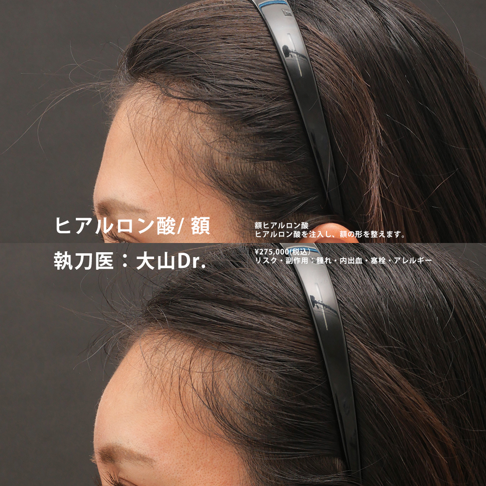 おでこのヒアルロン酸のその他の症例